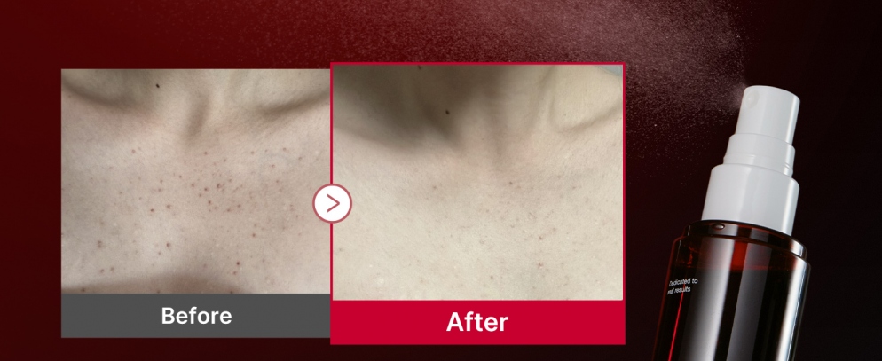 Red Acne Body Peeling Shot 2.0 110g3